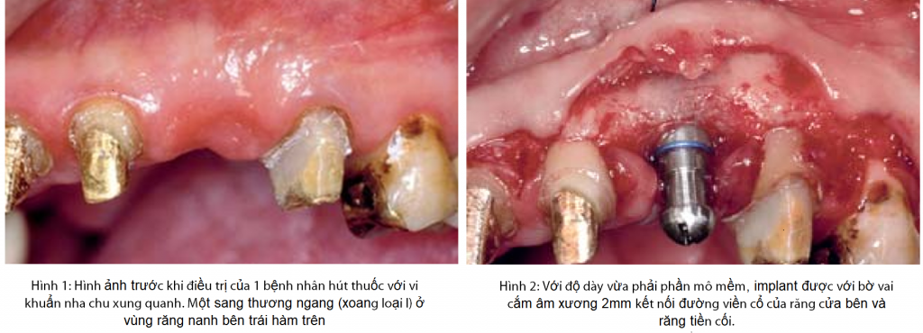 Tỷ lệ sinh học về độ cao và độ rộng của niêm mạc vòm miệng trên implant