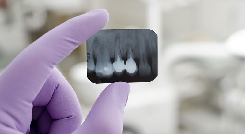 X quang cận chóp trong miệng, chụp được từ 3-4 răng