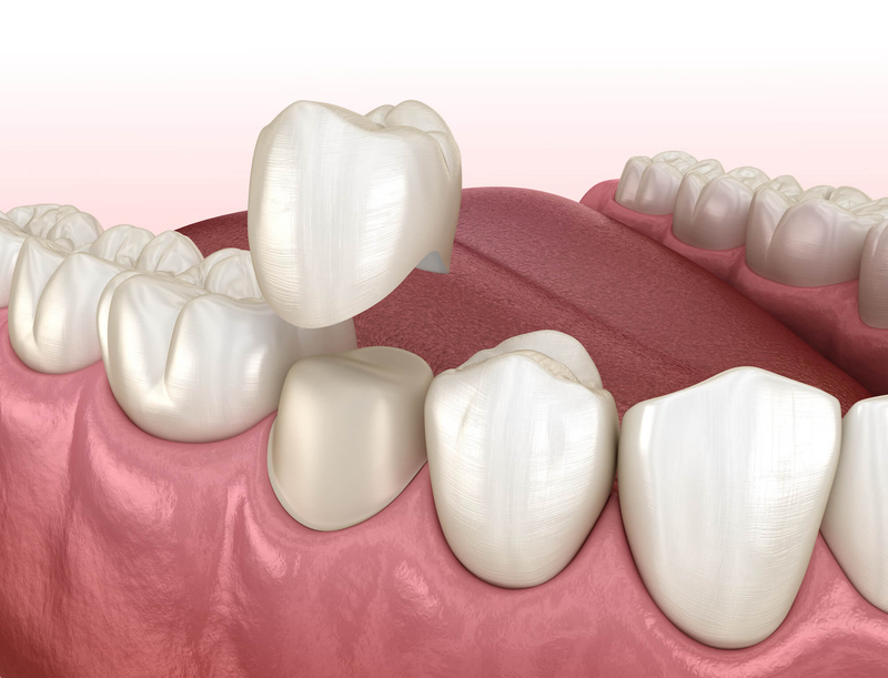 Vật liệu làm răng tạm truyền thông có độ cứng nhất định và khả năng chống mòn cao.